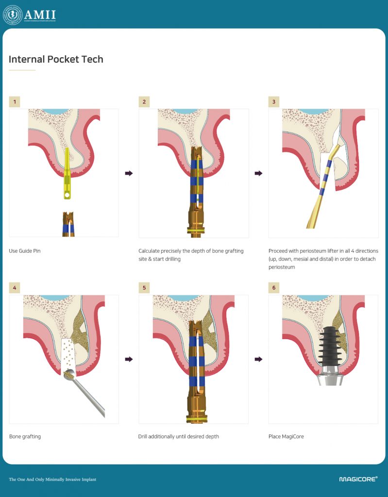 Internal Pocket Surgical System